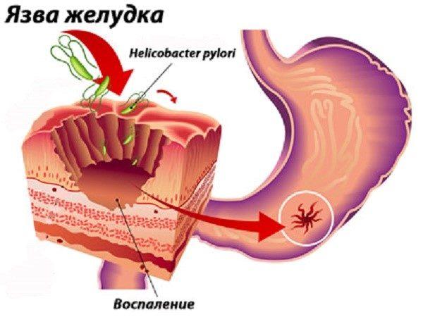 แผลในกระเพาะอาหาร