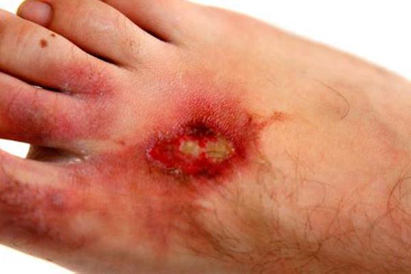 แผลไหม้ที่ขา