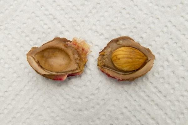 กระดูกแยก