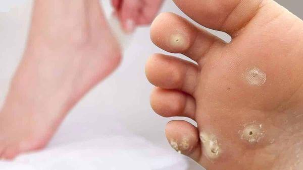 callosités sur les pieds