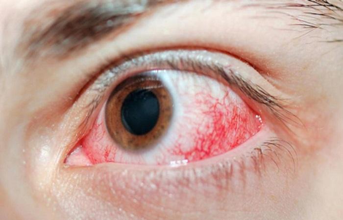 ตาสีแดง